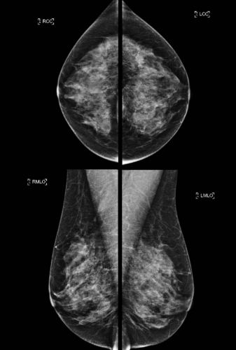 mammographie à Périgueux